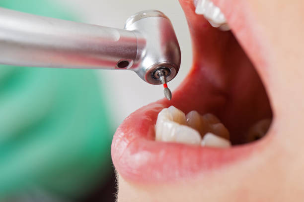 Best Emergency Wisdom Teeth Removal in Hyrum, UT